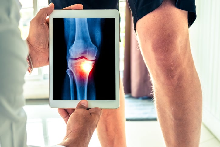 Eggshell membrane cuts osteoarthritis knee discomfort in large scale clinical trial