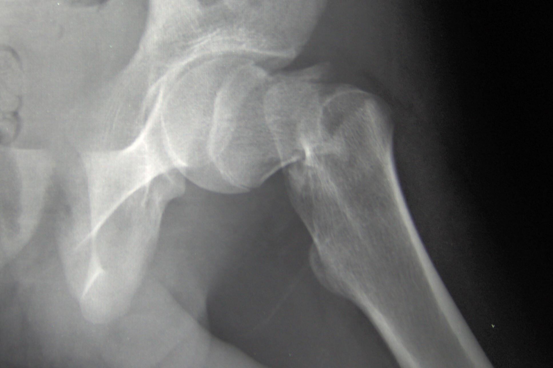 bone_xray_hip_fracture_skeleton.jpg