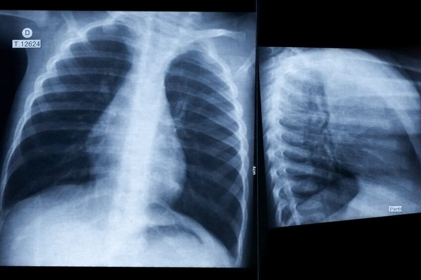 xray-chest-lungs.jpg