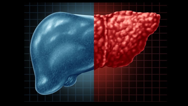 Probiotics shown to reduce fatty liver and increase Bifidobacterium in NAFLD patients – Taiwan study