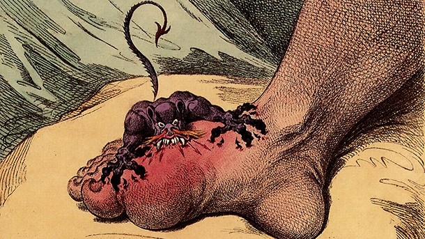 Gout, a 1799 caricature by James Gillray