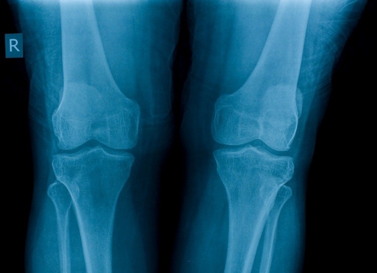 An estimated 50 million Americans suffer from osteoarthritis