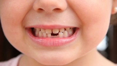 Cities with fluoridated water see half the tooth decay among kids